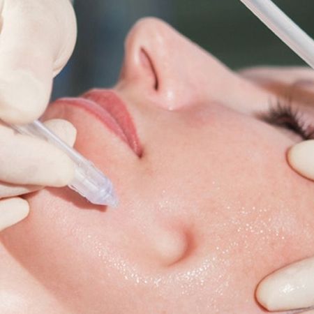 JetPeel Behandlung - Nahe Gesichtsaufnahme einer Kundin während der Behandlung