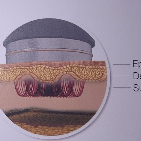 DermwavePro Behandlungstiefe